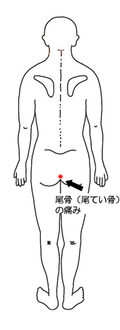 何もしていないのに尾骨(尾てい骨)が痛くなった 30代女性