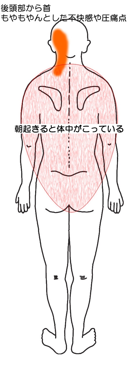 後頭部から首にもやもやんとした不快感と圧痛点。朝は体中のこりの図